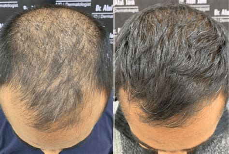 De Rol Van PRP In Haartransplantatie Behandelingen