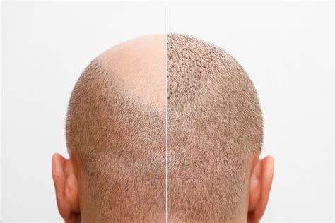Haartransplantatie En Nazorg: Hoe Zorg Je Voor Je Haar?