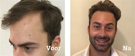 Haartransplantatie In Nederland: Ervaringen Van Klanten