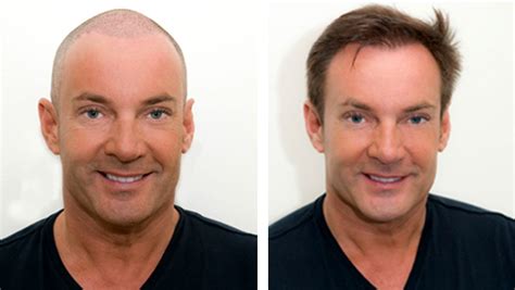 Haartransplantatie Resultaten: Voor En Na Foto's